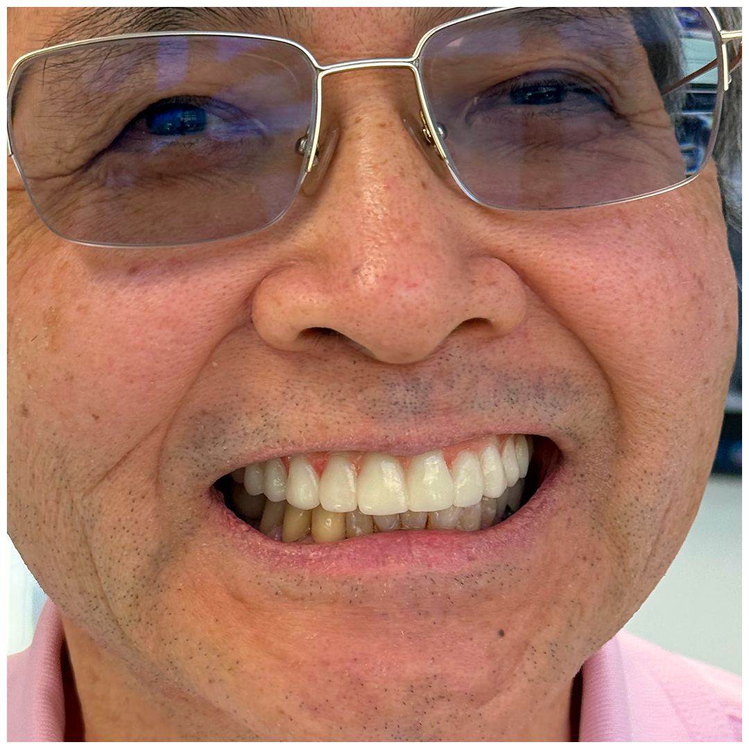 David after full-arch dental implant treatment at 3rdSET