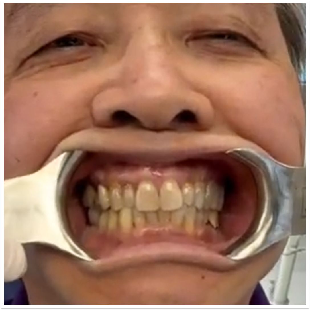 David before full-arch dental implant treatment