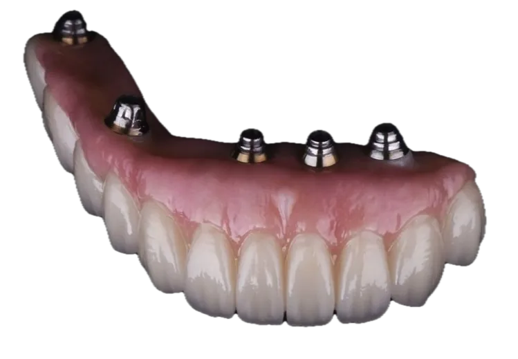 Close-up of a full-arch dental implant prosthesis with titanium connection points, the type of restoration placed at 3rdSET Implant Solutions