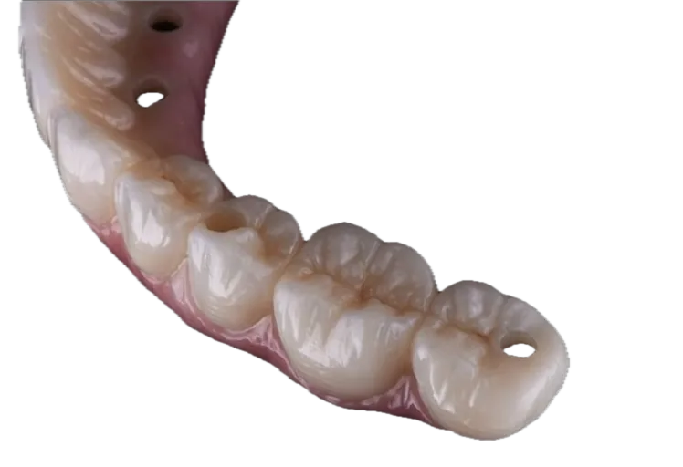 Implant-supported dental bridge seen from the biting surface, showing the screw-access channels that anchor it to implants